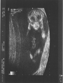 Scan at 13 weeks, 5 days