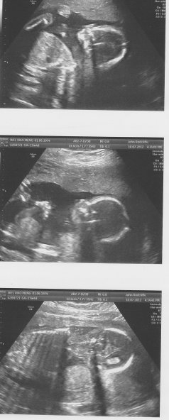 Scan at 20 weeks