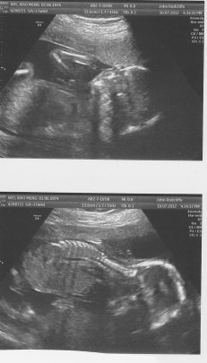 Scan at 20 weeks
