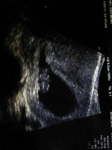 Scan at 9 weeks